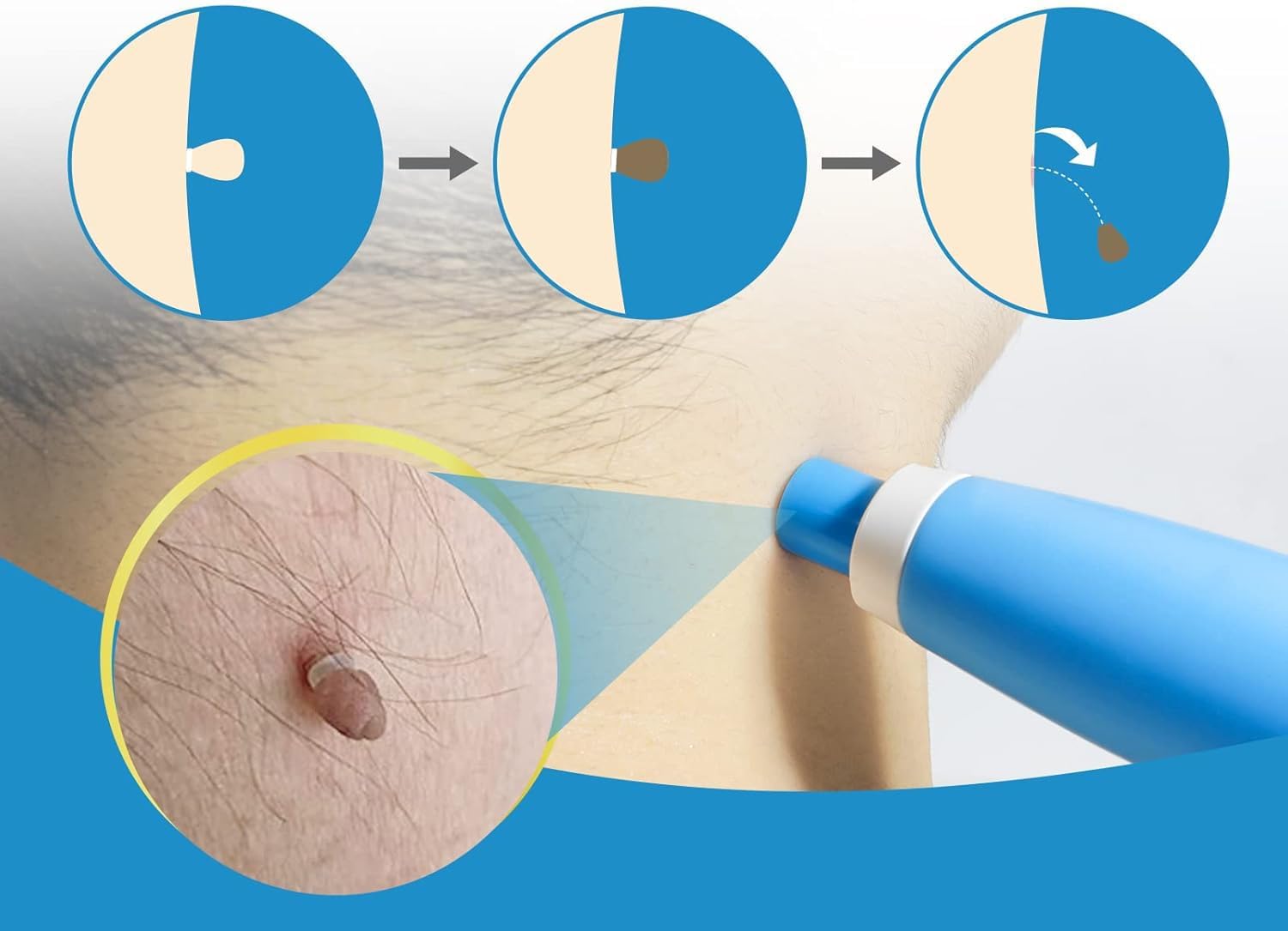 Painless Auto Skin Tag & Mole  - đánh giá và giá Health Wellness