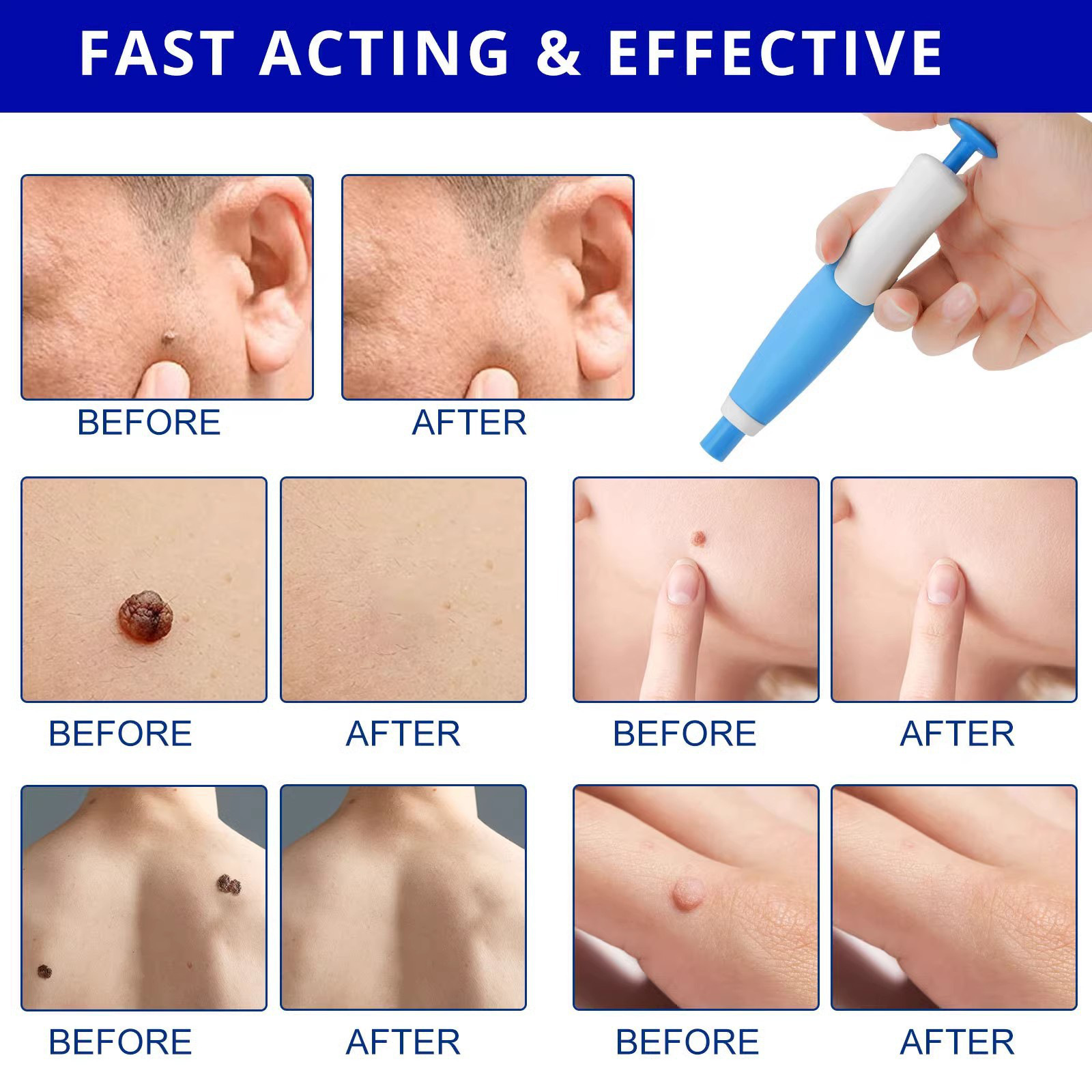 Painless Auto Skin Tag & Mole  - đánh giá và giá Health Wellness