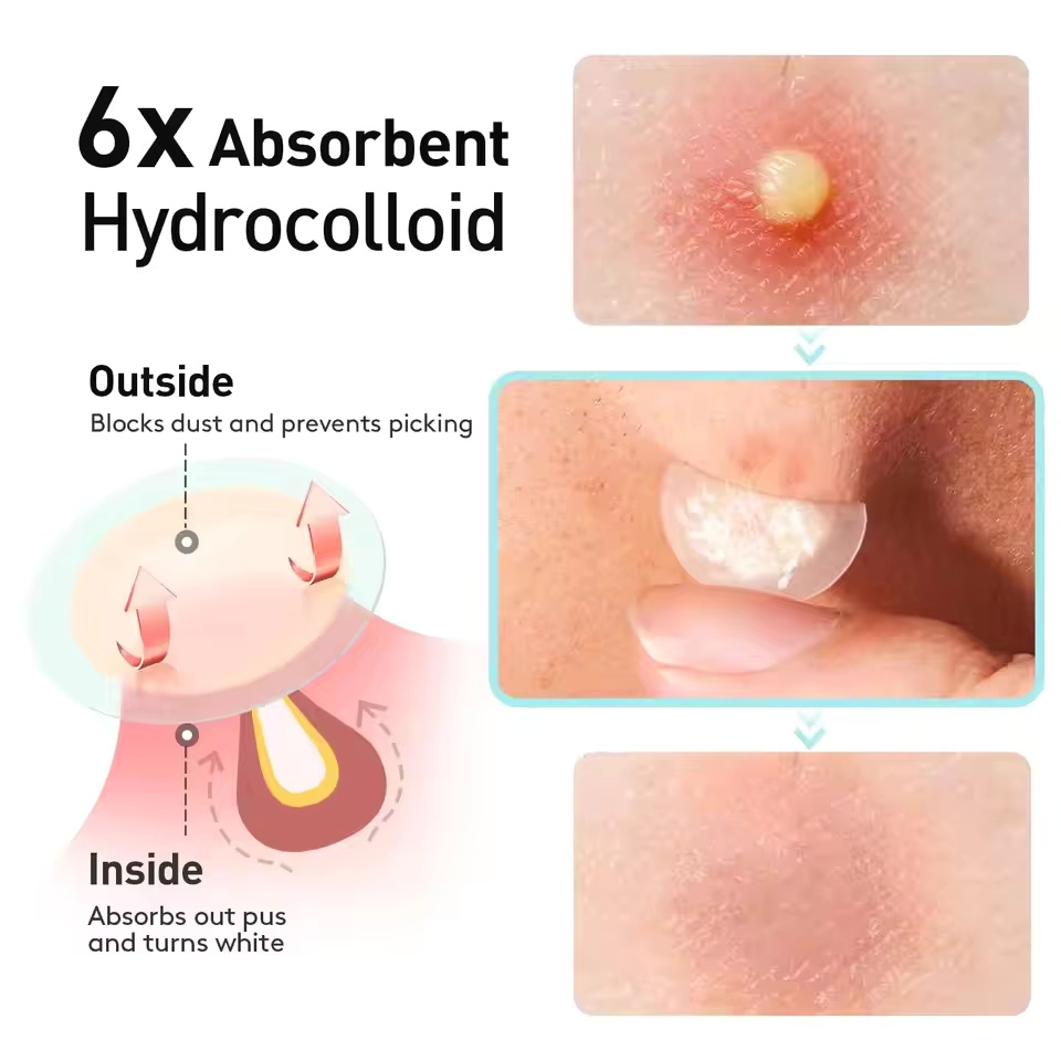 360 pieces/box acne patches -  - đánh giá và giá Essential Oils